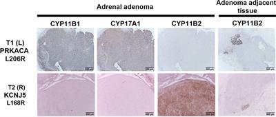 Case Report: Primary Aldosteronism Due to Bilateral Aldosterone-Producing Micronodules With HISTALDO Classical and Contralateral Non-Classical Pathology